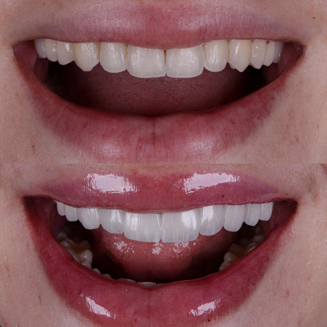 Antes e depois — Lentes de resina composta Método Coy